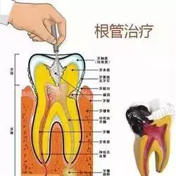 大名“根管治疗”，小名“抽神经”，诊疗要求：全冠保护