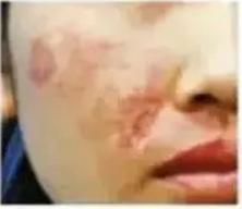 脸部填充脂肪能维持多久,自体脂肪面部填充后遗症