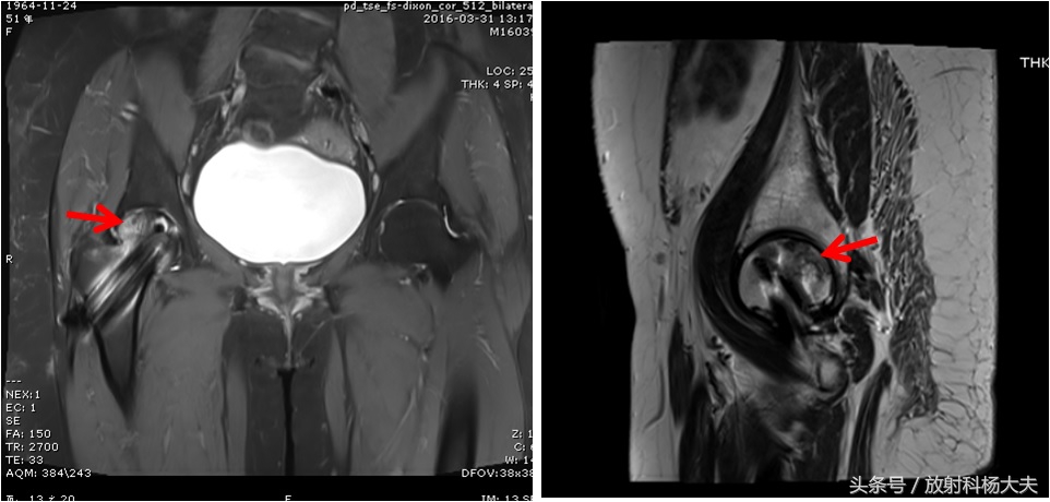 股骨骨折手术五个月拄拐杖走路疼,股骨头坏死手术后一个月腿弯疼
