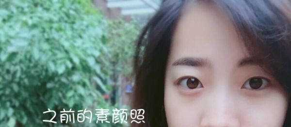 鼓起勇气做了个双眼皮,鼓起勇气做了医美