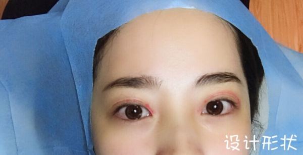 鼓起勇气做了个双眼皮,鼓起勇气做了医美