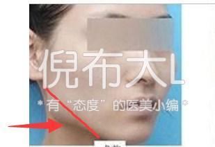 下颌角削多了变成马脸怎么修复,下颌角削骨有哪几种切法