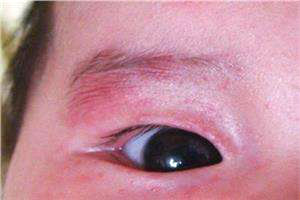 宝宝眼屎黄多是不是上火了,宝宝眼屎多且黄还粘稠怎么回事