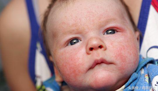 剖腹产疤痕如何快速去除,剖腹产疤痕怎么祛