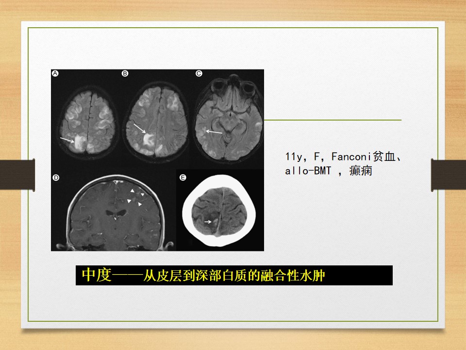 可逆性后部白质脑病综合征中央型,可逆性后部白质脑病综合征啥症状