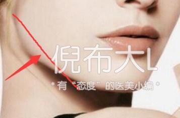 下颌角削多了变成马脸怎么修复,下颌角削骨有哪几种切法