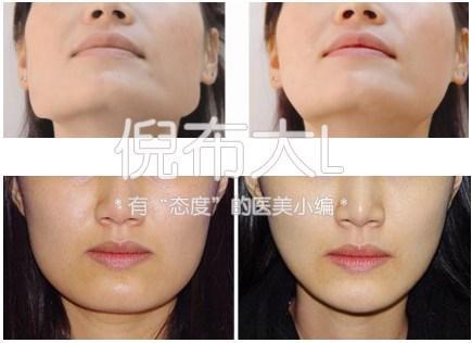 下颌角削多了变成马脸怎么修复,下颌角削骨有哪几种切法