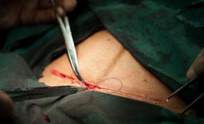 一层层,一刀刀切开孕妇肚子,剖腹产并不是你想象的那么简单