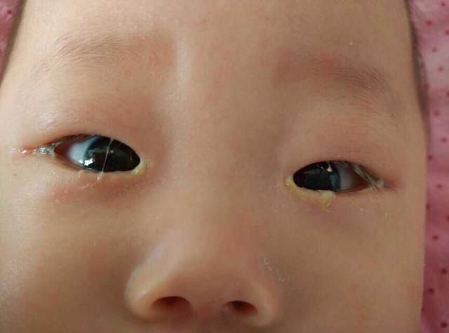 宝宝眼屎黄多是不是上火了,宝宝眼屎多且黄还粘稠怎么回事