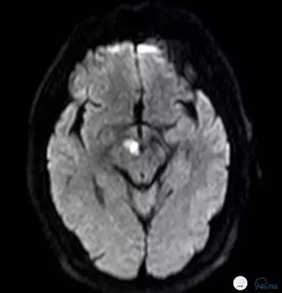 椎动脉狭窄支架植入术需要多少钱,颅内动脉狭窄支架手术后哪些症状