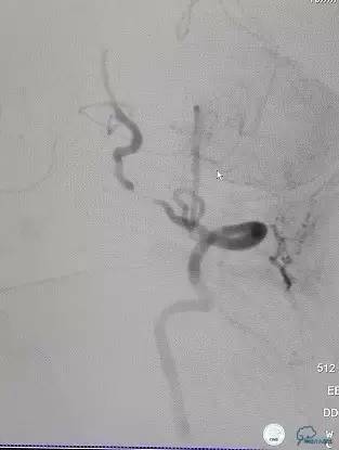 椎动脉狭窄支架植入术需要多少钱,颅内动脉狭窄支架手术后哪些症状