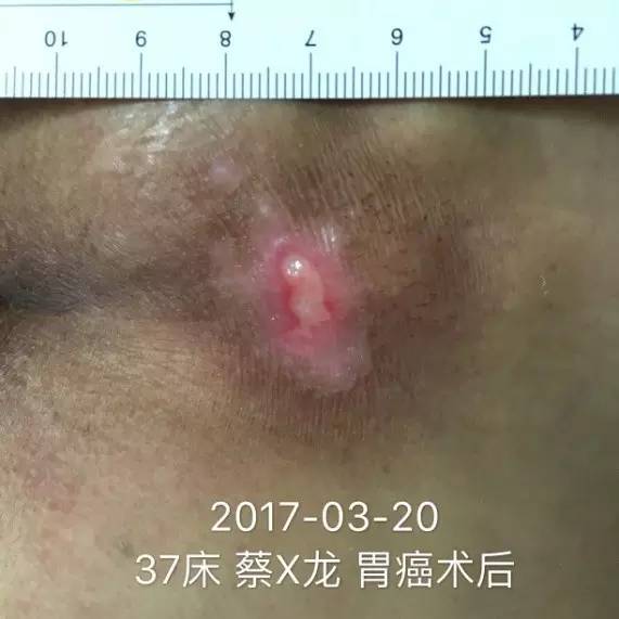 压疮贴的正确使用方法,压疮中药外敷治疗方法