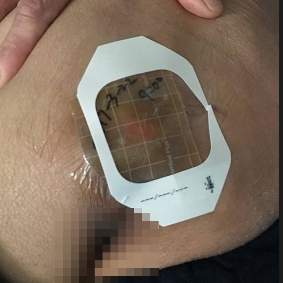 压疮贴的正确使用方法,压疮中药外敷治疗方法