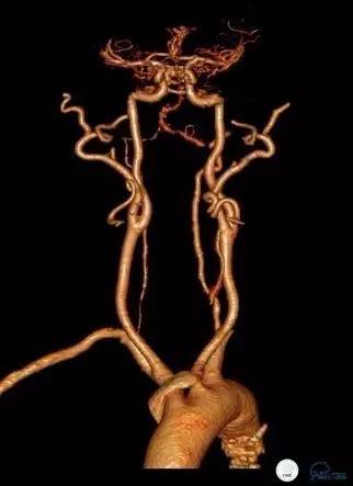 椎动脉狭窄支架植入术需要多少钱,颅内动脉狭窄支架手术后哪些症状