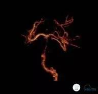 椎动脉狭窄支架植入术需要多少钱,颅内动脉狭窄支架手术后哪些症状