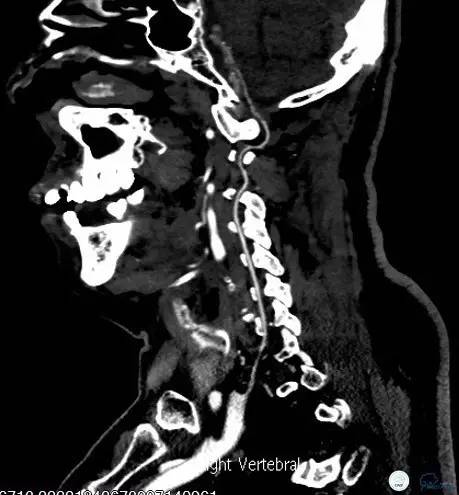 椎动脉狭窄支架植入术需要多少钱,颅内动脉狭窄支架手术后哪些症状