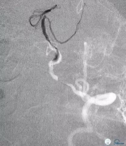 椎动脉狭窄支架植入术需要多少钱,颅内动脉狭窄支架手术后哪些症状