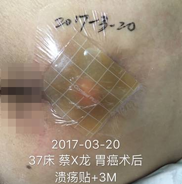 压疮贴的正确使用方法,压疮中药外敷治疗方法