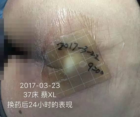 压疮贴的正确使用方法,压疮中药外敷治疗方法