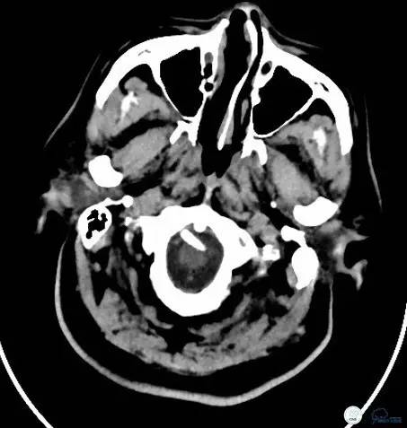 椎动脉狭窄支架植入术需要多少钱,颅内动脉狭窄支架手术后哪些症状