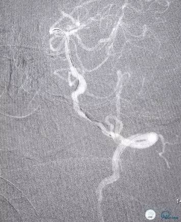 椎动脉狭窄支架植入术需要多少钱,颅内动脉狭窄支架手术后哪些症状