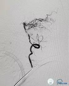 椎动脉狭窄支架植入术需要多少钱,颅内动脉狭窄支架手术后哪些症状