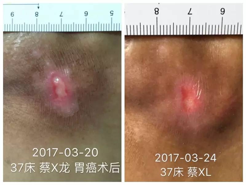 压疮贴的正确使用方法,压疮中药外敷治疗方法