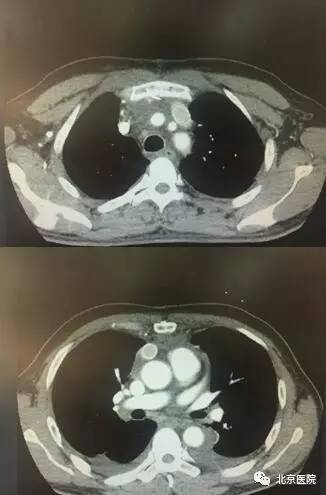 北京胸科医院肺切除术,北京胸科医院肺癌晚期手术