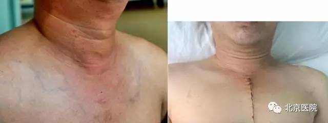 北京胸科医院肺切除术,北京胸科医院肺癌晚期手术