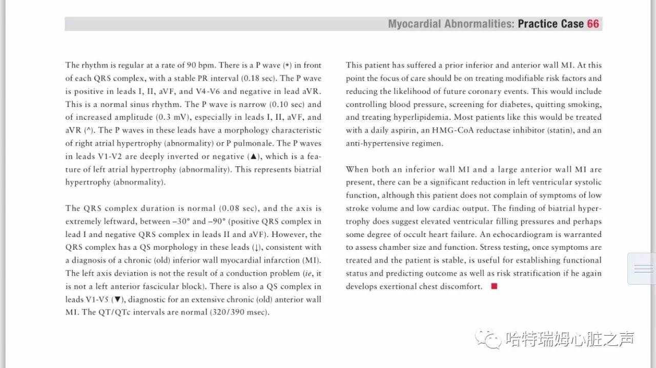 读心有术216,心电图出现双尖心室肥大