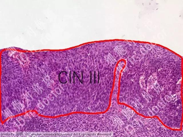 宫颈癌前病变cin2治愈率,宫颈管内癌前病变属于cin么