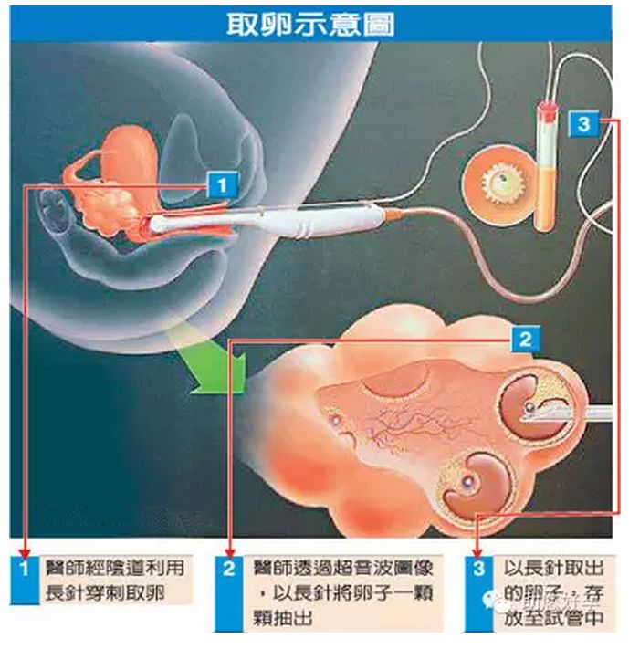 单身女性冻卵事件,年轻女性冻卵