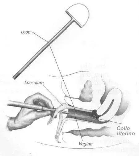 宫颈癌前病变cin2治愈率,宫颈管内癌前病变属于cin么