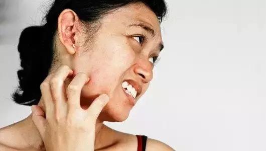 过敏荨麻疹是怎么来的,过敏性荨麻疹如何得的