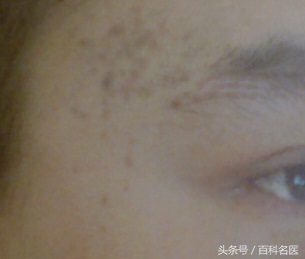 眼角和太阳穴长斑是怎么回事,眼角长斑的原因