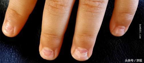 手足口引起的指甲脱落图片,孩子手足口半年了指甲还是烂