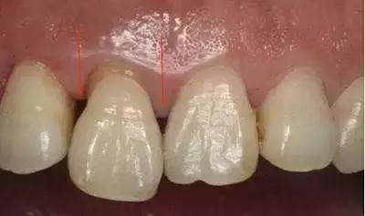 牙齿老是卡菜卡肉怎么办,牙齿卡肉导致牙痛