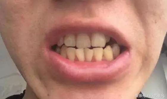 牙黄刷牙时加什么能变白,牙黄刷牙美白