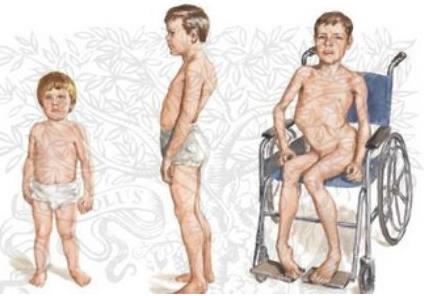 进行性肌营养不良症筛查,进行性肌营养不良问诊