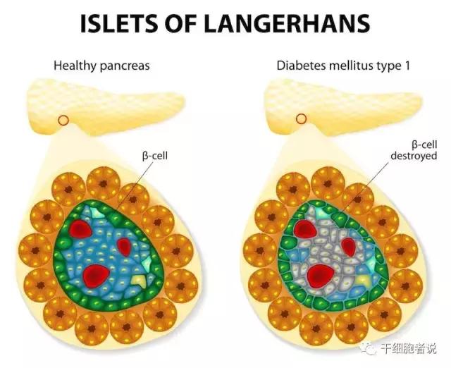 干细胞治疗1型糖尿病的最新进展,干细胞治疗1型糖尿病最新报道