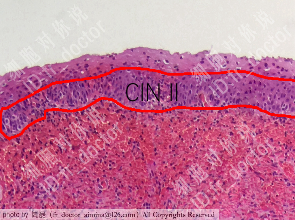 宫颈癌前病变cin2治愈率,宫颈管内癌前病变属于cin么