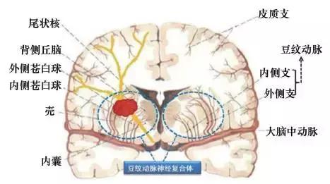 典型脑疾病——自发性脑出血研究进展与新理念