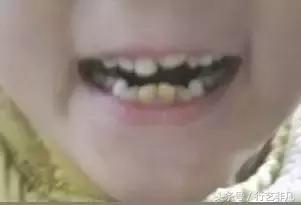 牙黄刷牙时加什么能变白,牙黄刷牙美白