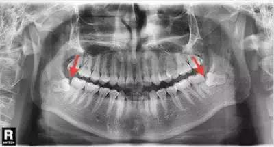 牙齿老是卡菜卡肉怎么办,牙齿卡肉导致牙痛