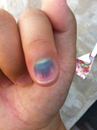 指甲被压了会感染吗,指甲被压淤血了会自己好吗