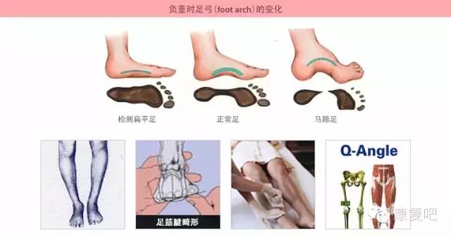 VIC健身：X型腿的矫正训练