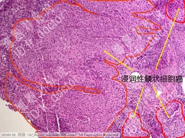 宫颈癌前病变cin2治愈率,宫颈管内癌前病变属于cin么
