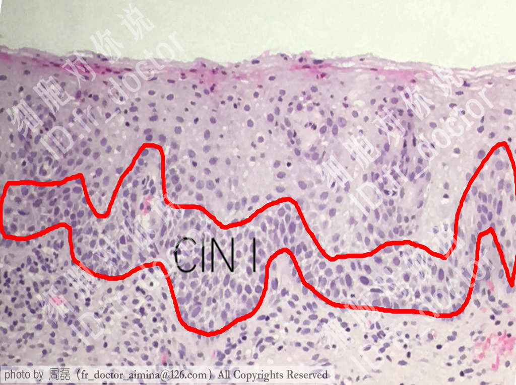 宫颈癌前病变cin2治愈率,宫颈管内癌前病变属于cin么