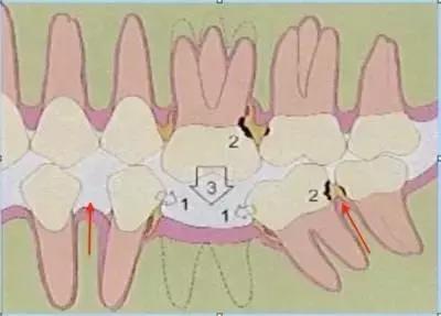 牙齿老是卡菜卡肉怎么办,牙齿卡肉导致牙痛