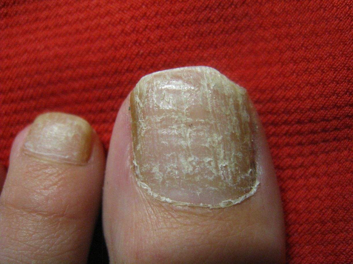 指甲被压了会感染吗,指甲被压淤血了会自己好吗